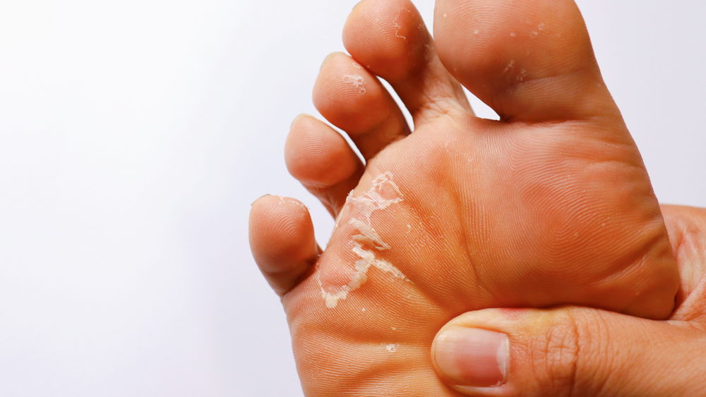 What is athlete's foot? And how is it transmitted?